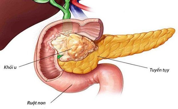 Ung thư lúc đầu không đau nhưng thấy 8 dấu hiệu khi đi vệ sinh thì nên đi khám sớm: Đừng chủ quan