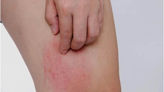 Hai bộ phận trên cơ thể ngứa ngáy là dấu hiệu của bệnh UT gan, nhiều người lại lầm tưởng là dị ứng Hai bộ phận trên cơ thể ngứa ngáy là dấu hiệu của bệnh UT gan, nhiều người lại lầm tưởng là dị ứng