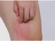 Hai bộ phận trên cơ thể ngứa ngáy là dấu hiệu của bệnh UT gan, nhiều người lại lầm tưởng là dị ứng