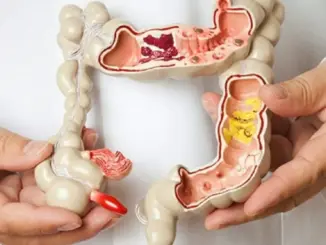 Nếu có polyp trong ruộtt, khi đi vệ sinh sẽ có 4 dấu hiệu này, đi khám ngay kẻo muộn