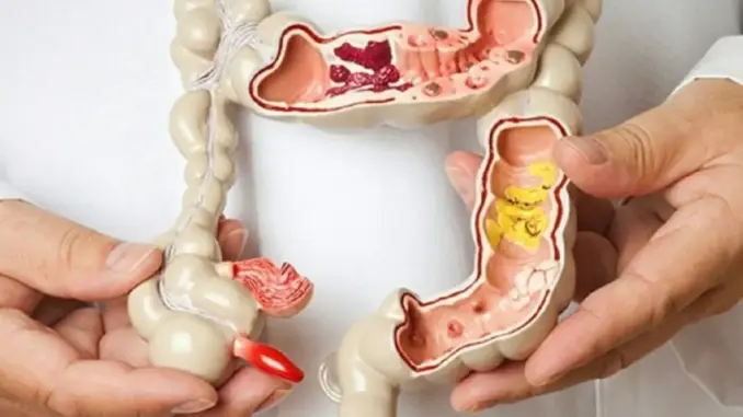 Nếu có polyp trong ruộtt, khi đi vệ sinh sẽ có 4 dấu hiệu này, đi khám ngay kẻo muộn