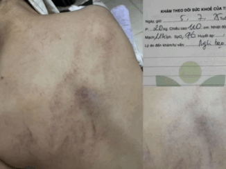 Bé gái 4 tuổi nghi bị cô giáo bạo hành: Bộ Y tế yêu cầu khẩn trương xác minh, hỗ trợ