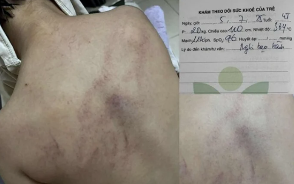 Bé gái 4 tuổi nghi bị cô giáo bạo hành: Bộ Y tế yêu cầu khẩn trương xác minh, hỗ trợ Bé gái 4 tuổi nghi bị cô giáo bạo hành: Bộ Y tế yêu cầu khẩn trương xác minh, hỗ trợ