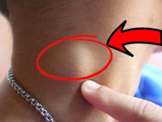 Người sắp bị K tấn công thường có 3 dấu hiệu lạ ở cổ, có dù chỉ 1 cũng báo động sức khoẻ