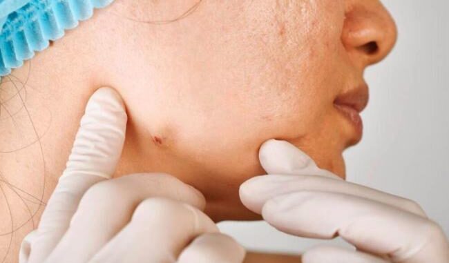 3 loại “mụn” này trên cơ thể có thể là u-ng thư, dù nam hay nữ, ở độ tuổi nào cũng đừng bỏ qua 3 loại “mụn” này trên cơ thể có thể là u-ng thư, dù nam hay nữ, ở độ tuổi nào cũng đừng bỏ qua